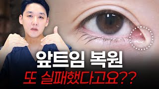 앞트임복원 더이상 실패는 없다