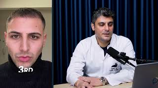 4000 Grafts Hair Transplant | 12-Month Case Study by Dr. Gökay Bilgin