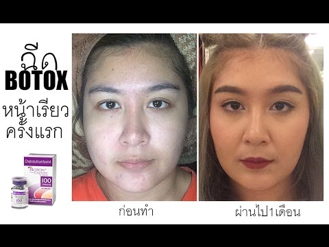 เมโสแฟต ยี่ห้อไหนดี