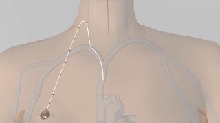 Portacatheter placement for chemo explained