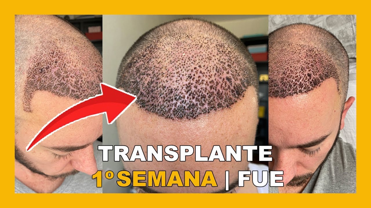 TRANSPLANTE CAPILAR - CICATRIZAÇÃO E PRIMEIROS DIAS PÓS OPERATÓRIO