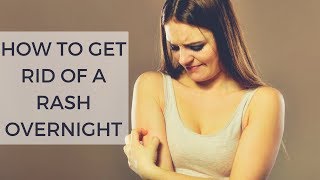How To Get Rid Of A Rash Overnight || How to get rid of heat rash quickly || Health Domain 2018
