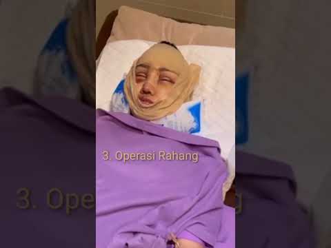 Inilah Wajah Lucinta Luna Pasca Operasi