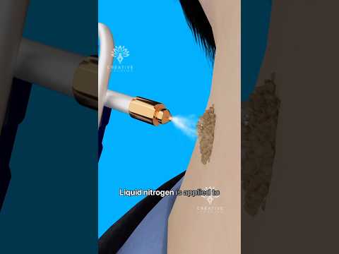How Cryotherapy Removes Warts Safely #shorts #wartsremoval #viralvideo - Creativelearning3d