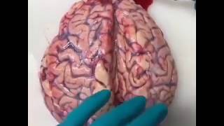 Intracerebral hemorrhage discovered during brain autopsy! 💉💉 ... more information in description