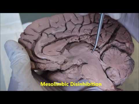 Video 8 MesoLimbic Lesion Positive Schizo Rx