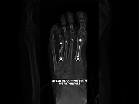 From Short Toes to Perfect Feet: Patients Amazing Transformation!