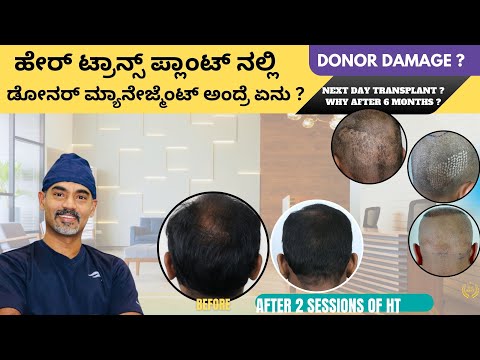 Hair Transplant In Bangalore | Best Clinic Cost &...