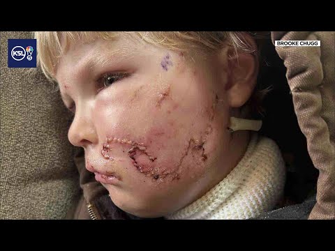 5-year-old boy faces long recovery after dog attack in Hurricane