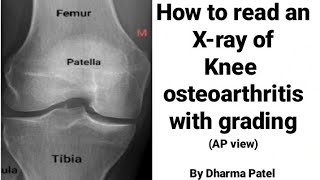 How to read knee joint X-ray in knee osteoarthritis | Normal Knee X ray | Ortho X ray interpretation