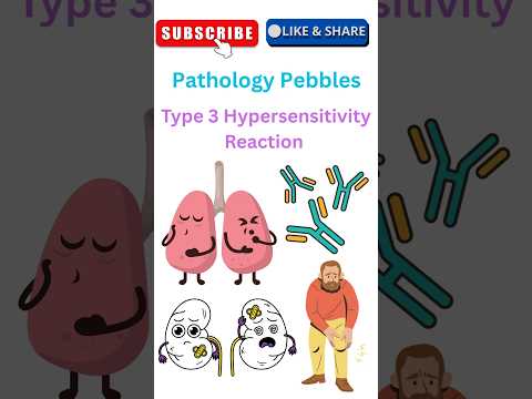 Type 3 Hypersensitivity Reaction made super easy 💡🏮💡