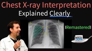 Download Lagu Chest X Ray Interpretation Explained Clearly - How to read a chest Xray Thumbnail