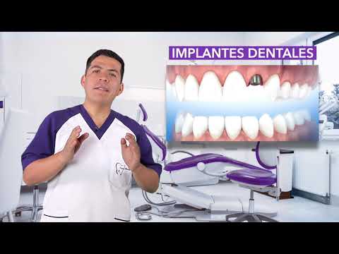 ¿Qué es un IMPLANTE DENTAL? 🤔