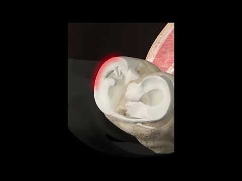 تعرف علي هطوات عملية الغضروف الهلالي بالمنظار