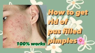 How to get rid of pus filled pimples | acne treatment at home | trying out @MeriumPervaiz remedy