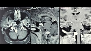 Download Lagu FORAMENA MAGNUM MENINGIOMA-- MICROSURGERY-LATERAL APPROACH-dr suresh dugani/HUBBALLI/KARNATAKA/INDIA Thumbnail