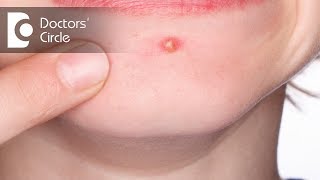 Causes and management of Scabies with pus filled pimples - Dr. Aruna Prasad