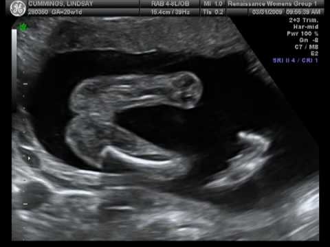 Ryleigh Michelle Ultrasound - 20 weeks