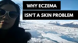 Why Your Eczema Isn't a Skin Problem (Discover The Iceberg Analogy)