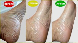 IN JUST 5 MINUTES GET RID OF CRACKED HEELS, HOW TO TREAT DRY, CRACKED HEELS AND FEET AT HOME
