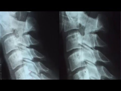 MRT des Hüftgelenkprothese Wie man Osteochondrose Halswirbel gewinnen