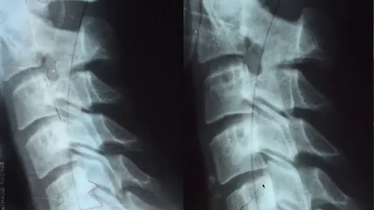 Proof that you can fix bone spurs in the spine without surgery - YouTube