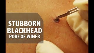 Stubborn Blackhead Removal | Dr. Derm