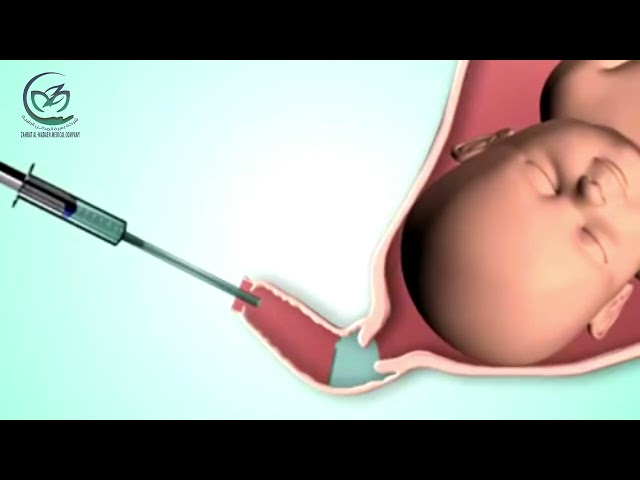 جينوتال جل الولادة