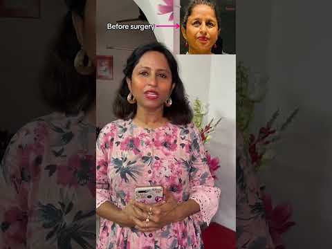 Blepharoplasty Experience