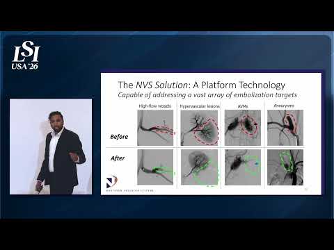 Joel Ramjist, Northern Vascular Systems, Inc. - Light-activated embolic platform for vascular treatment | LSI USA '26