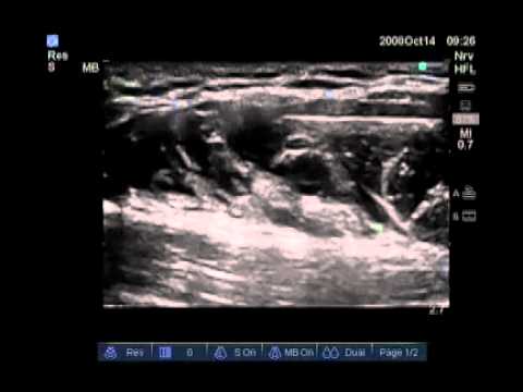 How To: Ultrasound-Guided Axillary Brachial Plexus Nerve Block Scanning Technique Video