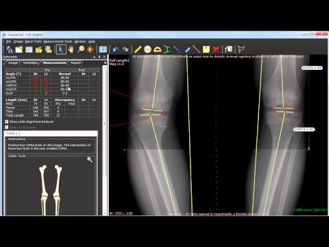 Deformity Correction Planning