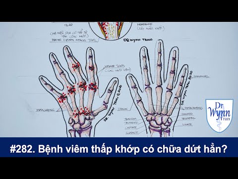 Viêm thấp khớp có thể chữa dứt hẳn? Cập nhật chẩn đoán và chữa trị