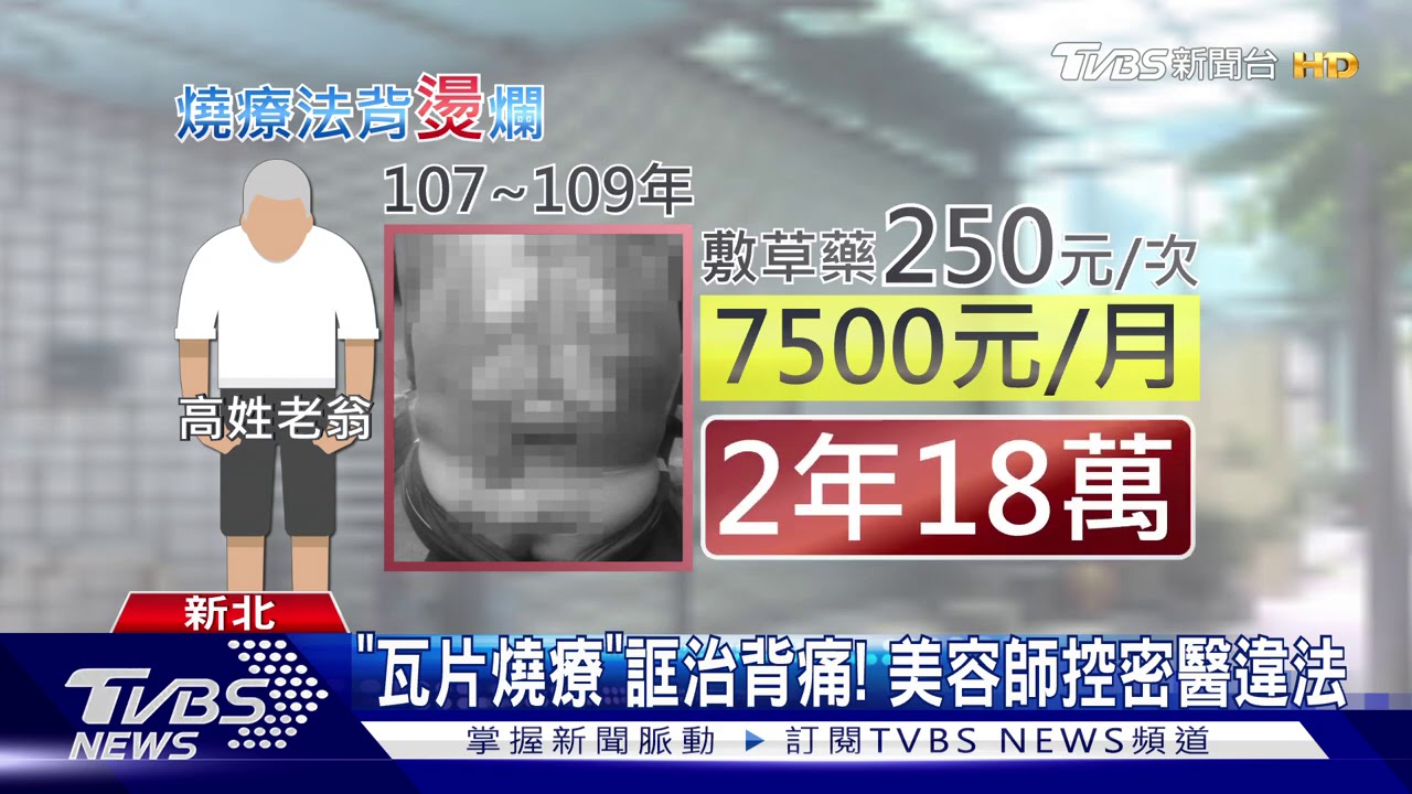 全潰爛!控密醫拔罐烤洞 害翁「背留坑疤」