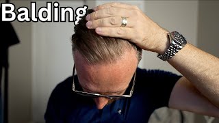 Balding and Hair Loss 