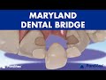 MARYLAND Bridge A DENTAL BRIDGE Alternative For Missing Teeth