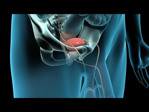 Prostata, wo sie auf der Außenseite Chronische Prostatitis Rezepte