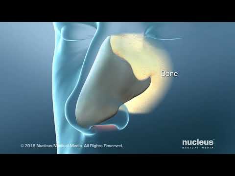 Deviated Septum Surgery (Septoplasty) for Difficulty in Breathing