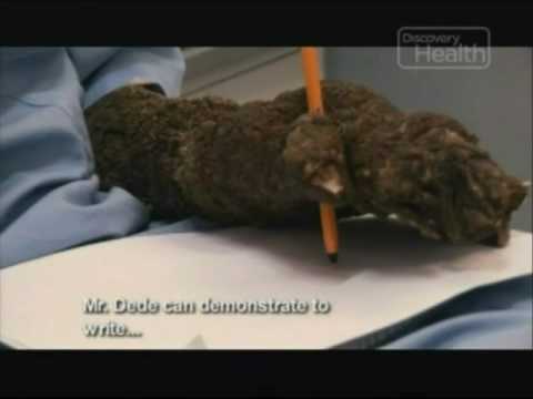 Treeman: The Surgery - Part.4