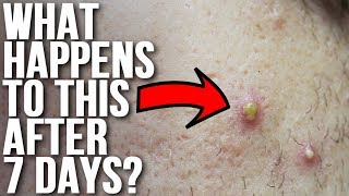 Don&#39;t Touch Your Acne &amp; See What Happens!