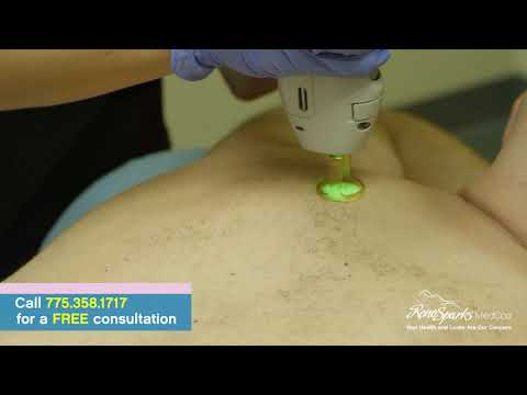 Laser Hair Removal for Men and Women - Reno Sparks...