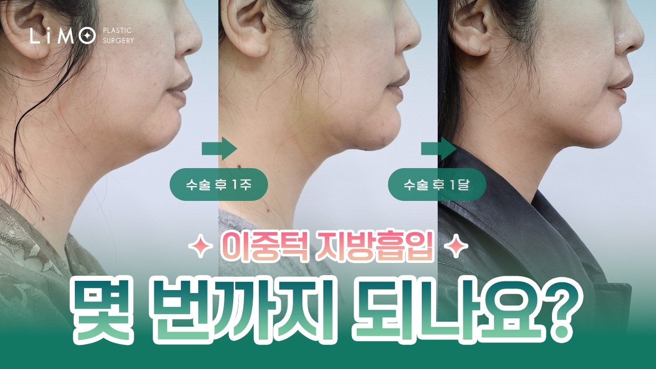 리모성형외과 유튜브 영상