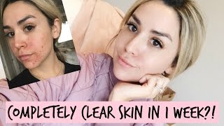 CLEAR EVEN SKIN IN 1 WEEK! CHEMICAL PEEL RESULTS + ACNE STORY