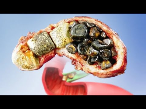 The Top 3 Best Gallbladder Herbs