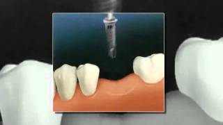preview picture of video 'Dental Implants Round Lake Beach IL - Den-Care Smile Center'