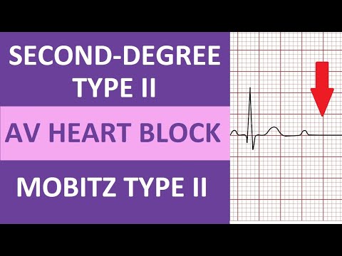 Second Degree Type Ii Av Heart Block Mobitz Ii Ecg Review Second Degree Type Ii Av Heart Block Mobitz Ii Ecg Review
