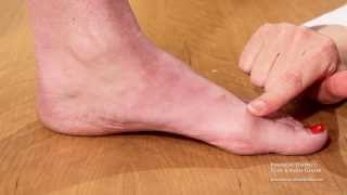 preview picture of video 'Functional Hallux Limitus - Physician Version - FDFAC - San Francisco - Dr. Jenny Sanders'