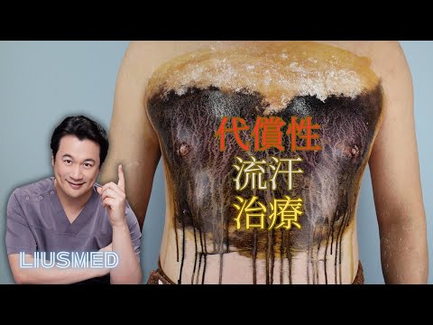 代償性多汗症治療：非侵入性熱解離技術