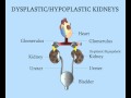 Dysplastic/Hypoplastic Kidneys