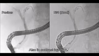 Radiation exposure dose and influencing factors during endoscopic retrograde